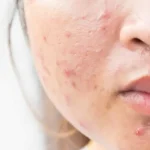 Ways to Get Rid of Acne Naturally That Are Powerful and Effective