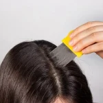 How to Get Rid of Head Lice